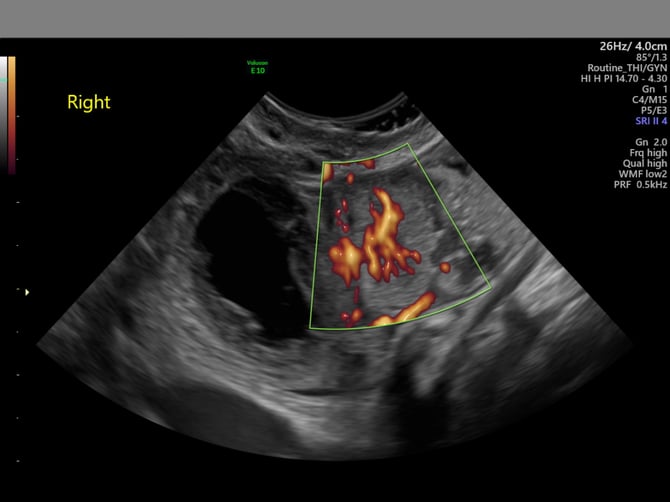 Collective Minds Ultrasound US study anonymized grey pixel overlay